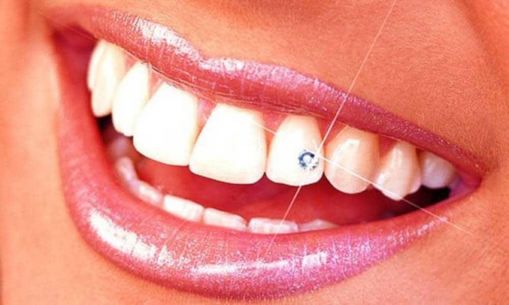 Dental piercing (dental gem)